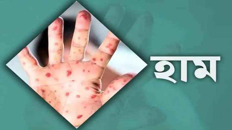 বান্দরবানে হামে আক্রান্ত হয়ে ২ শিশুর মৃত্যু, আক্রান্ত ১৪১৯ জন